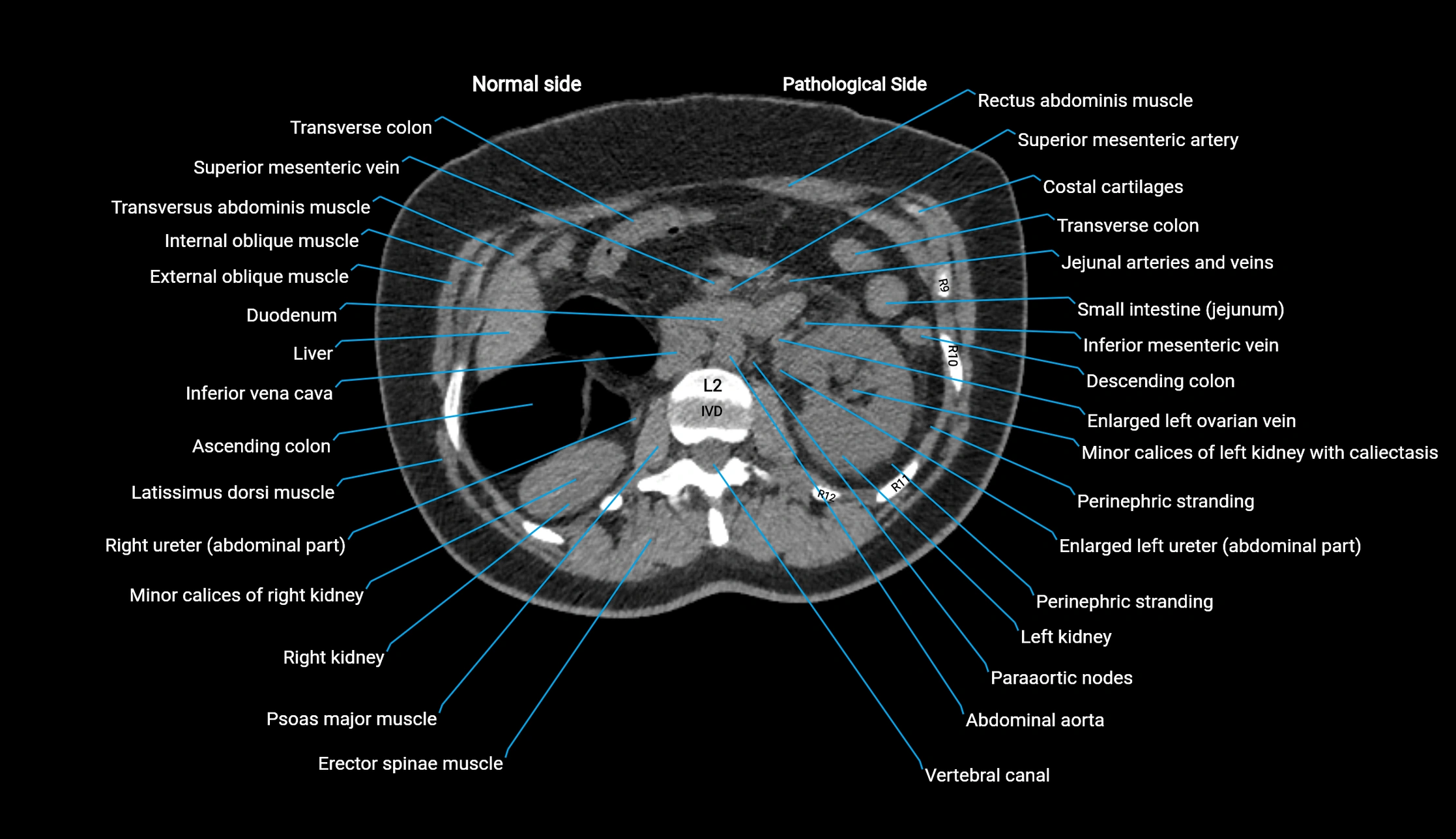 CT KUB axial cross sectional anatomy  radiology image -img-00201-00049.webp
